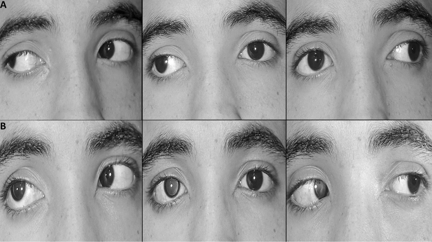 Better baseline stereoacuity and distance fusion were associated with better treatment outcomes in patients with intermittent exotropia who underwent office-based VT, as these findings indicate stronger baseline sensory fusion. This study suggests that baseline convergence amplitude alone may be less predictive of functional recovery following VT than sensory measures.